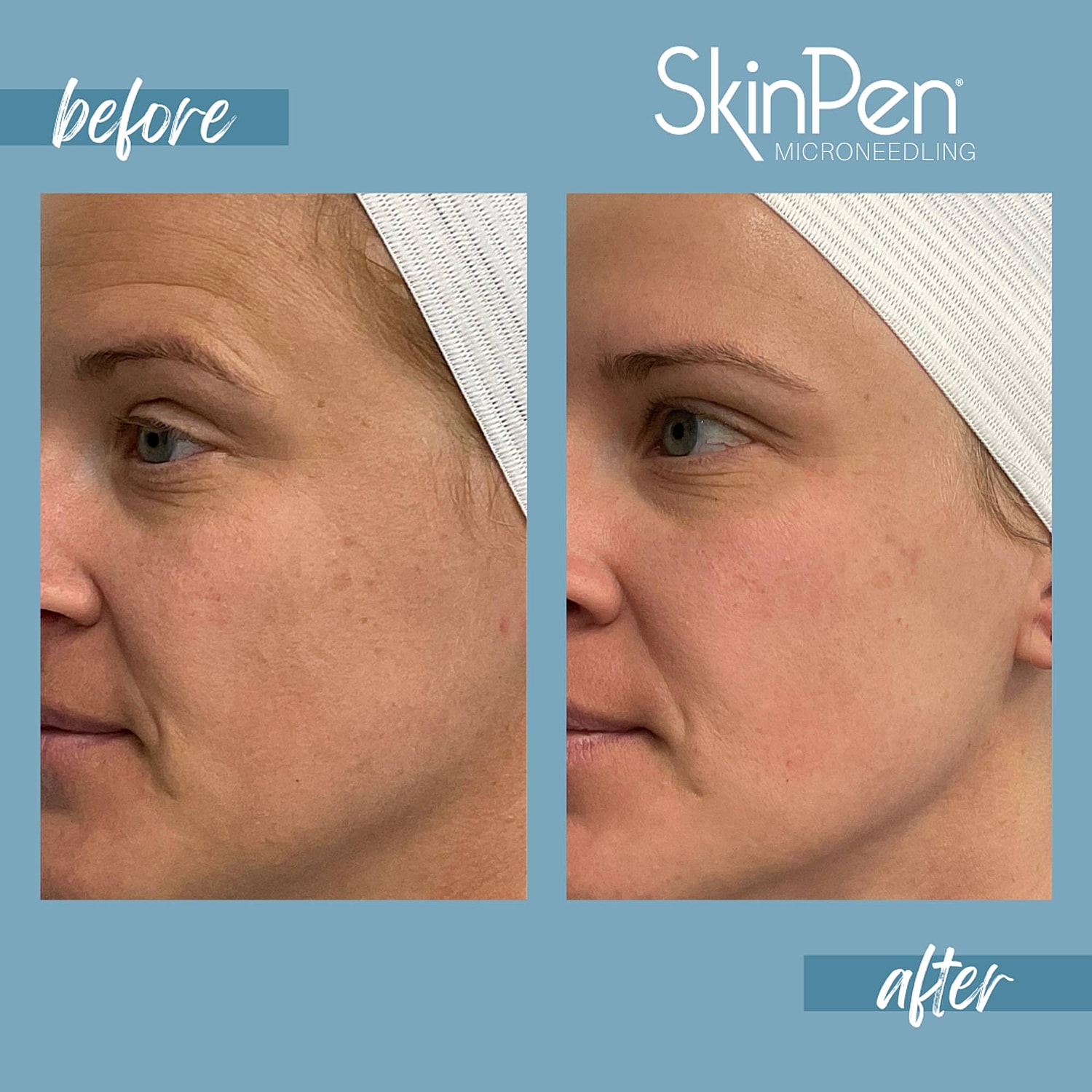 Microneedling Before & After