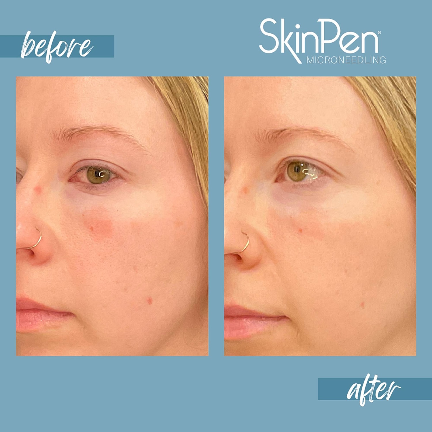 Microneedling Before & After
