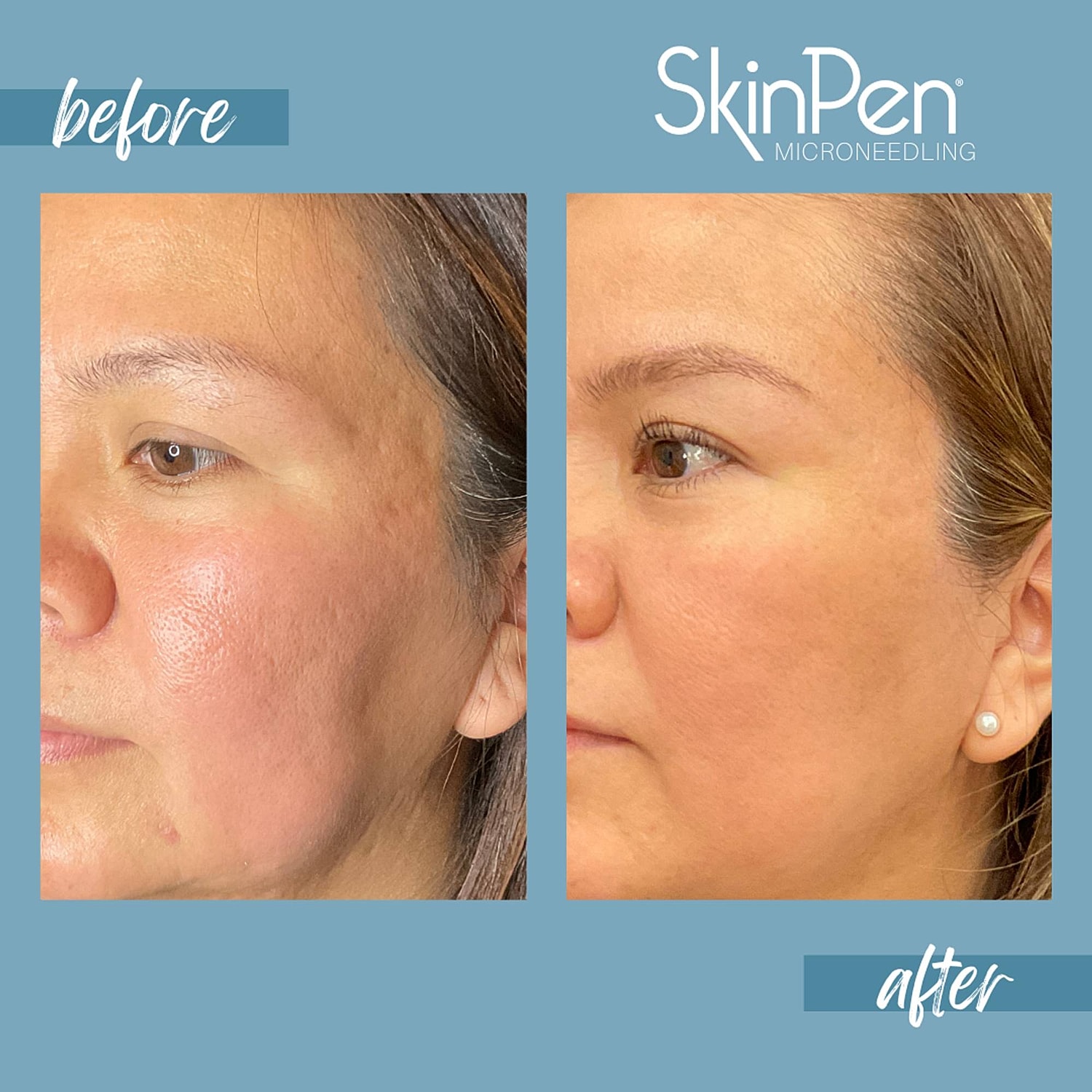 Microneedling Before & After