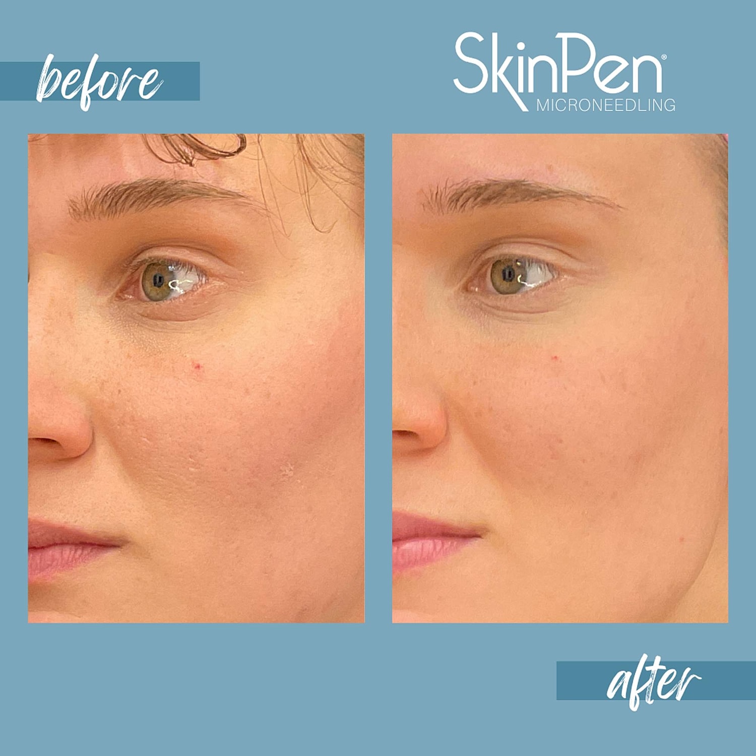 Microneedling Before & After