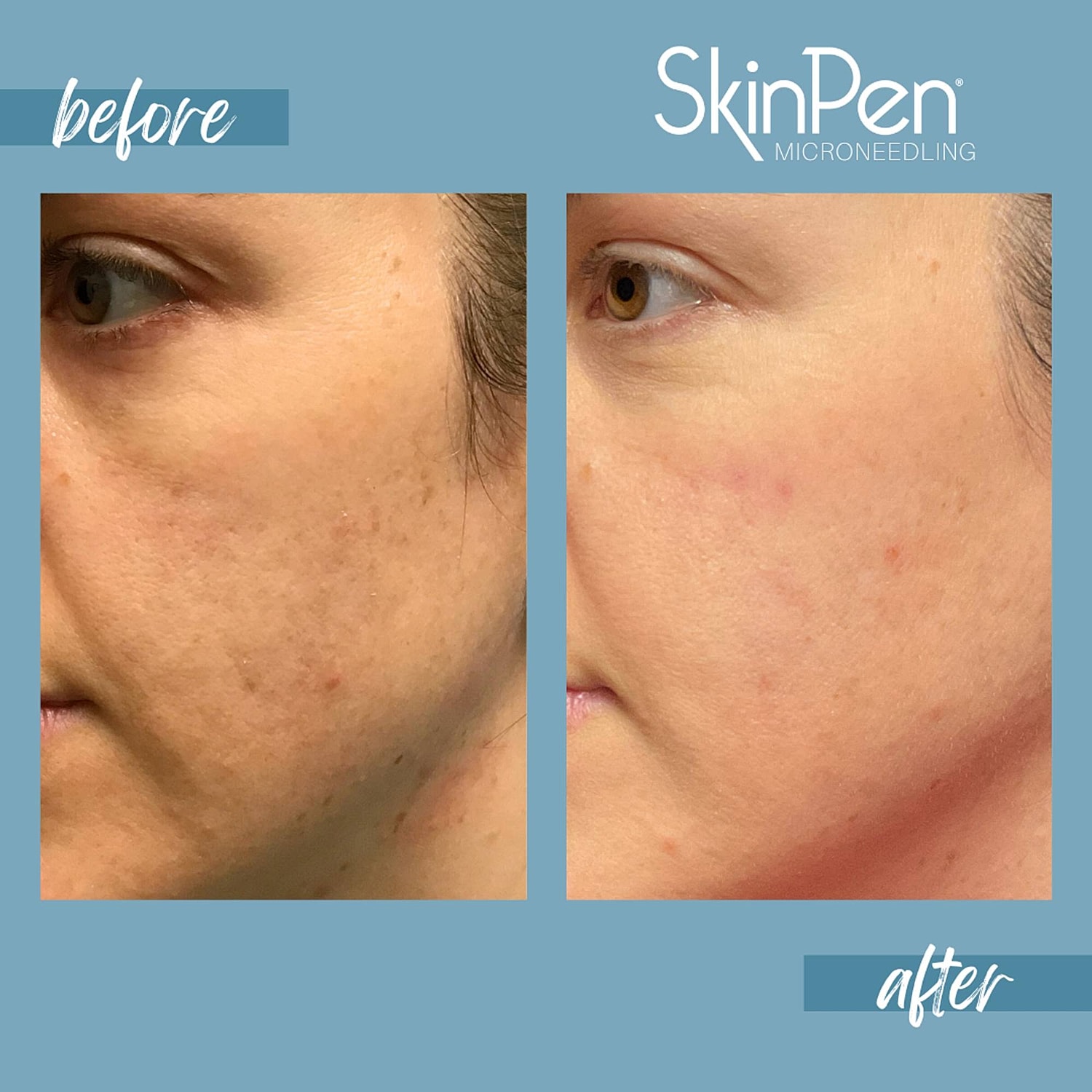 Microneedling Before & After