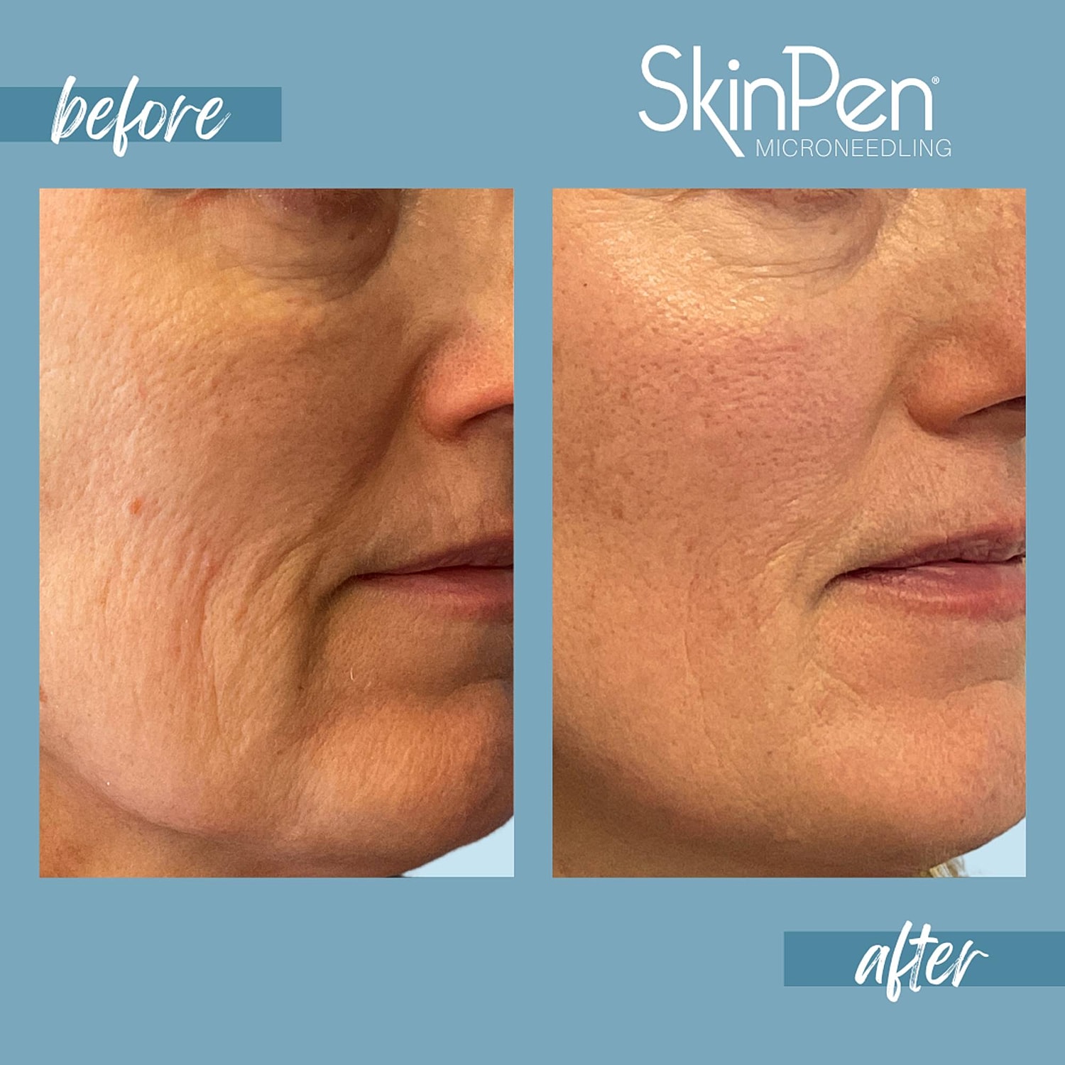Microneedling Before & After