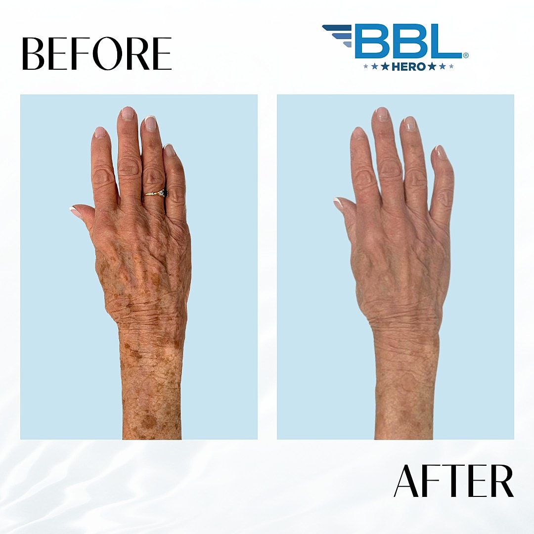 Broad Band Light (Bbl) Before & After