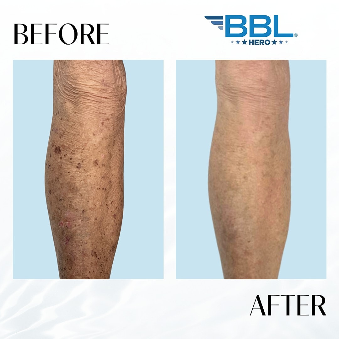 Broad Band Light (Bbl) Before & After