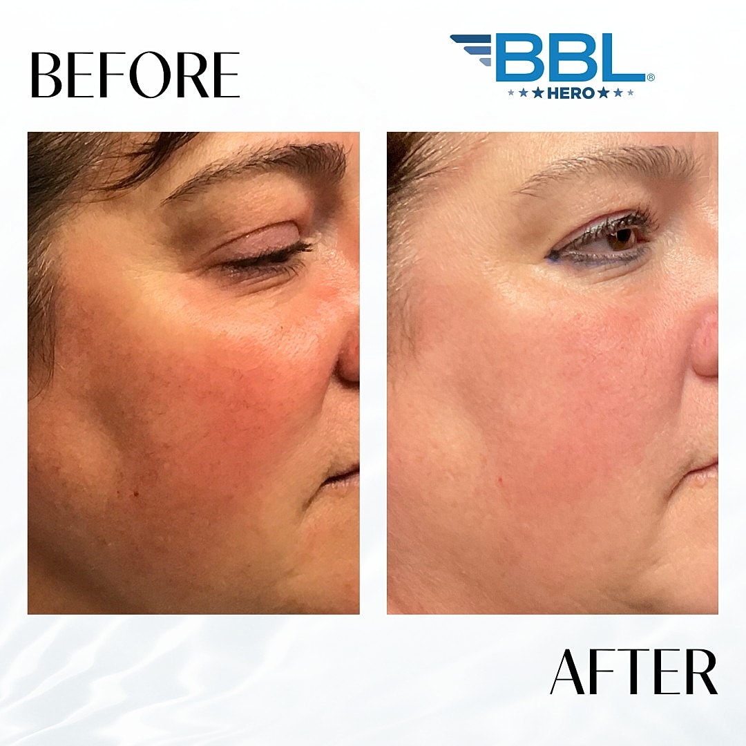 Broad Band Light (Bbl) Before & After