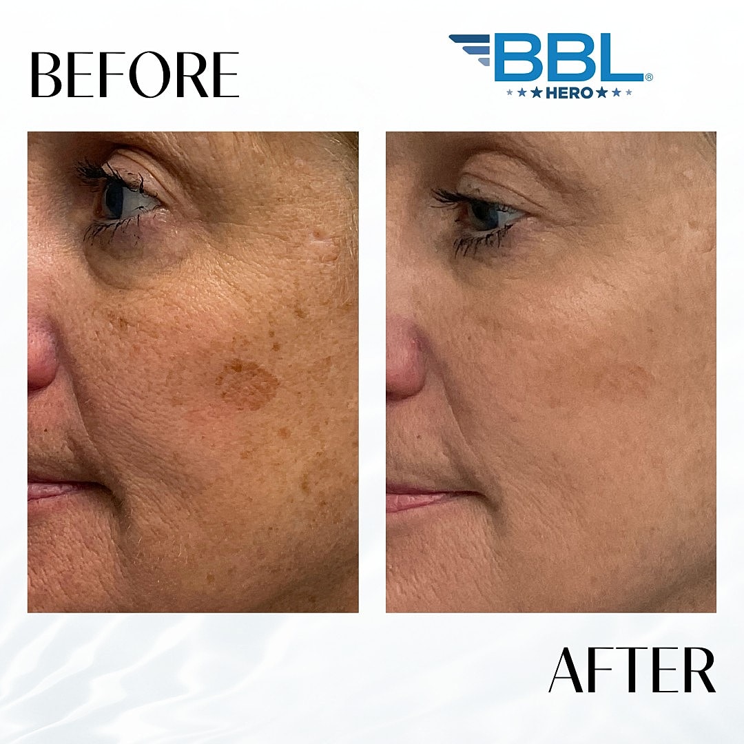 Broad Band Light (Bbl) Before & After