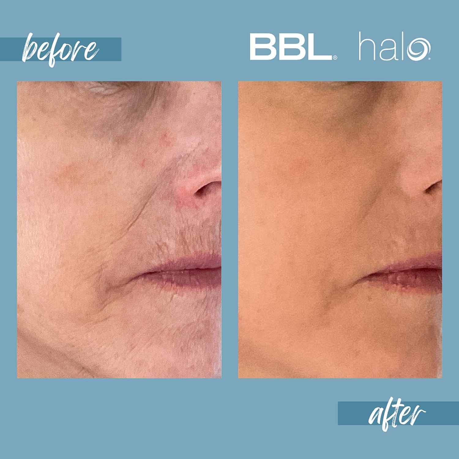 Halo Laser Before & After