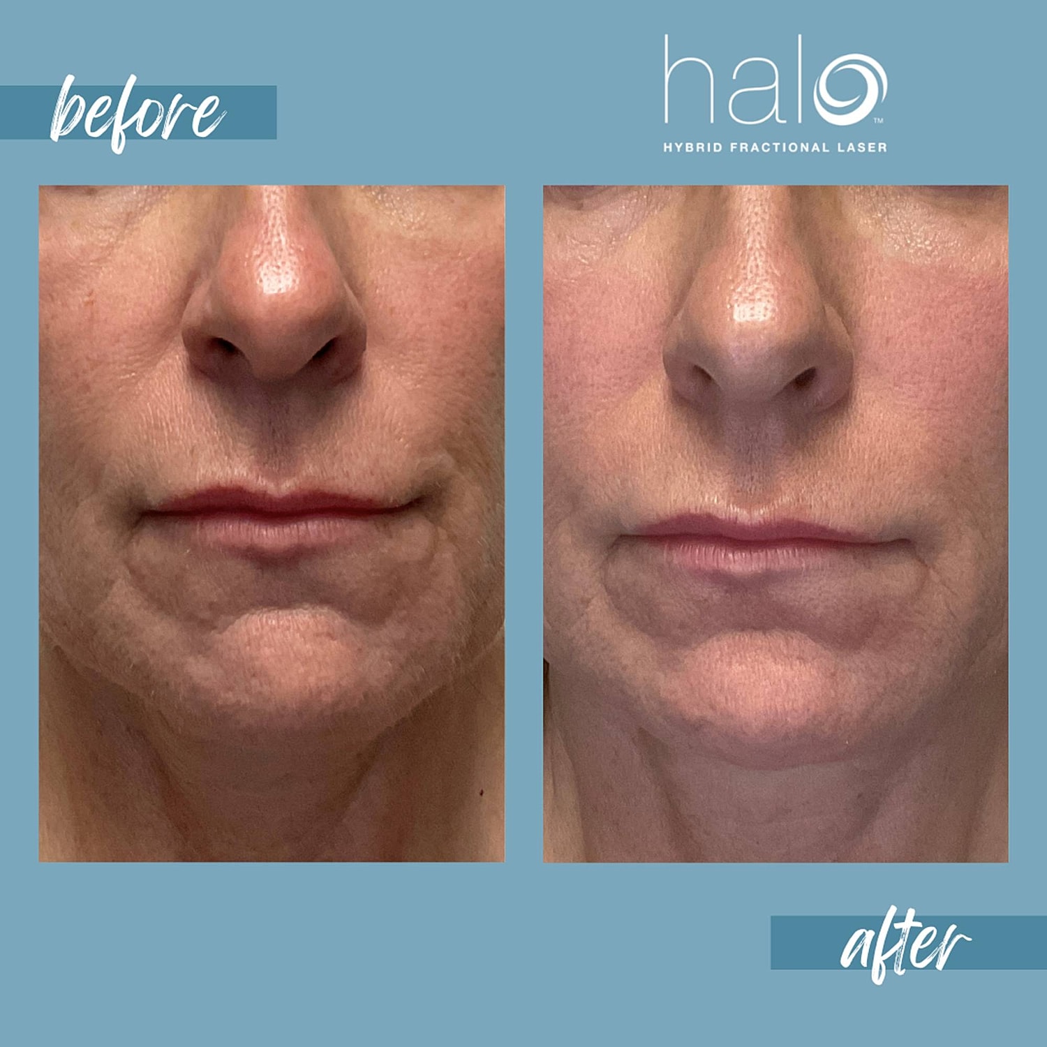 Halo Laser Before & After