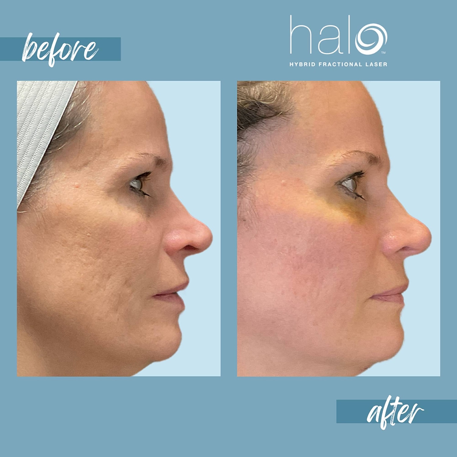 Halo Laser Before & After