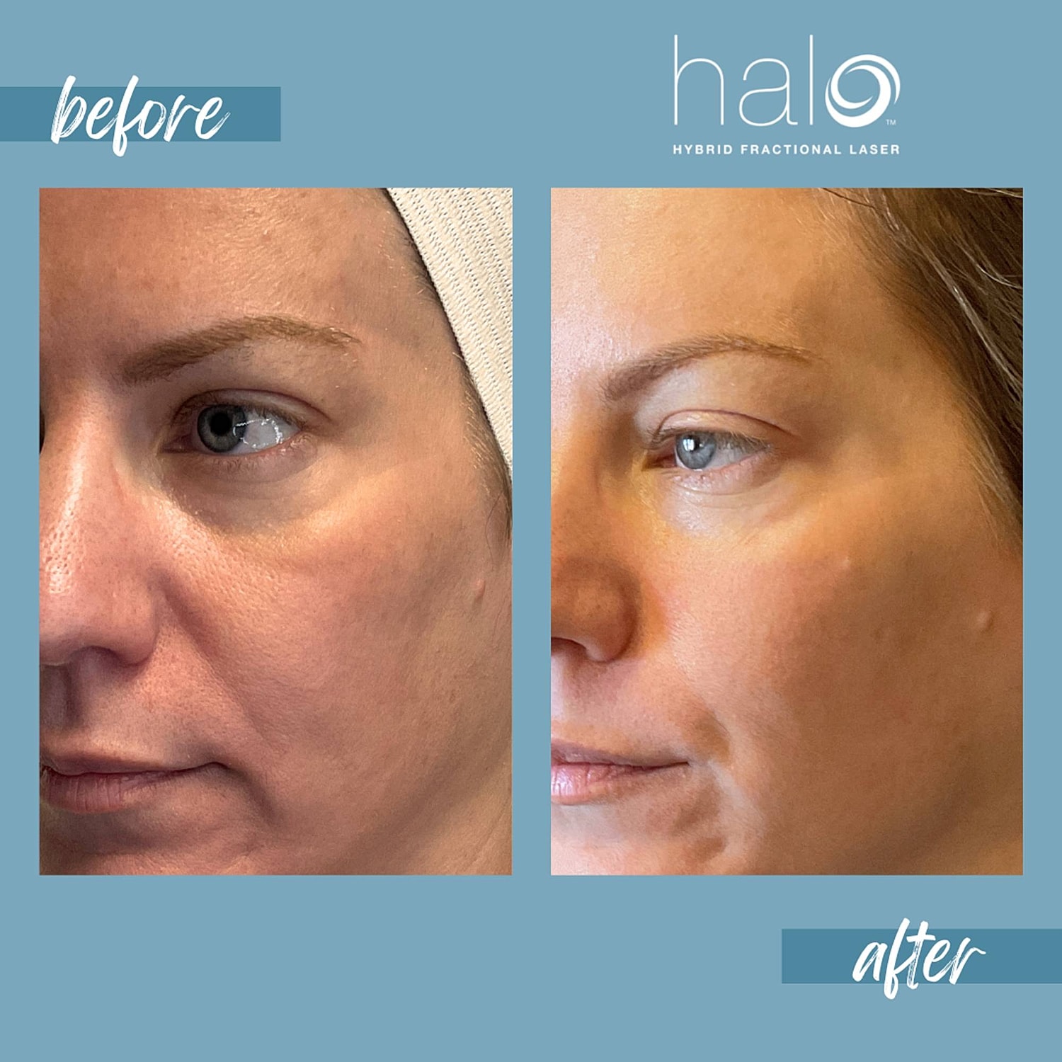 Halo Laser Before & After