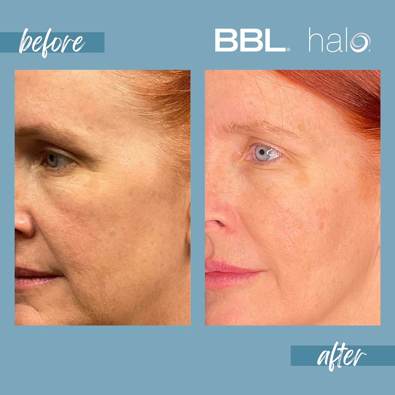 Halo Laser Before & After