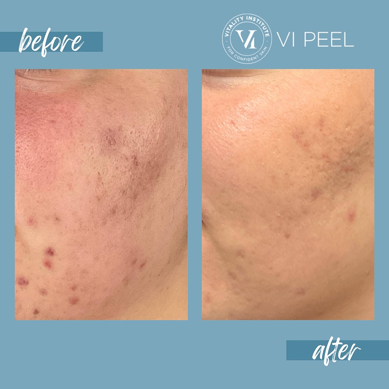 VI Peel Before & After