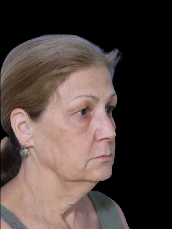 Deep Plane Facelift Gallery Before & After