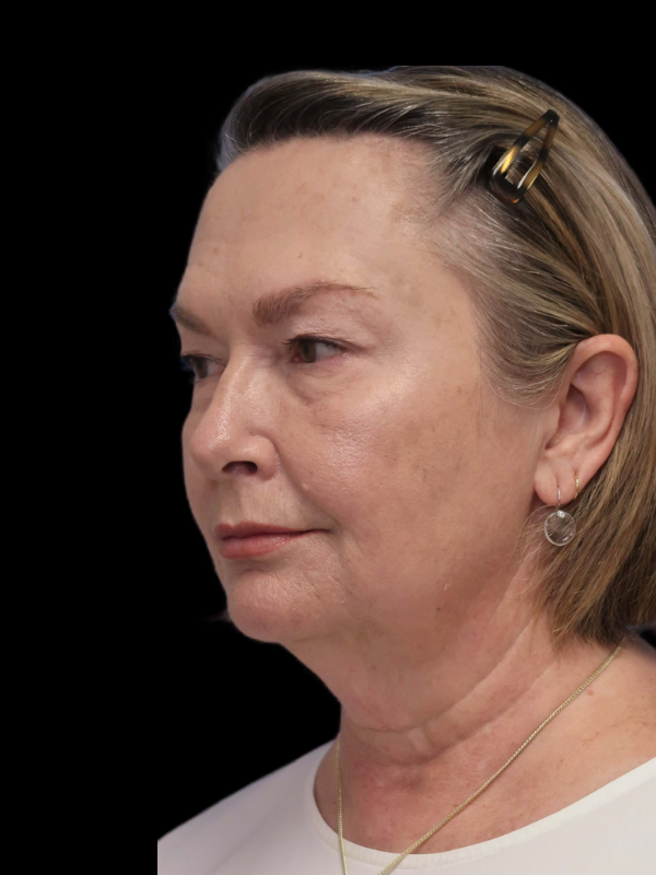 Endoscopic Browlift Gallery Before & After