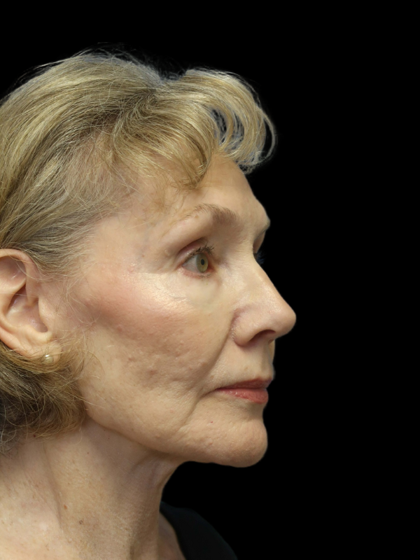 Endoscopic Browlift Gallery Before & After