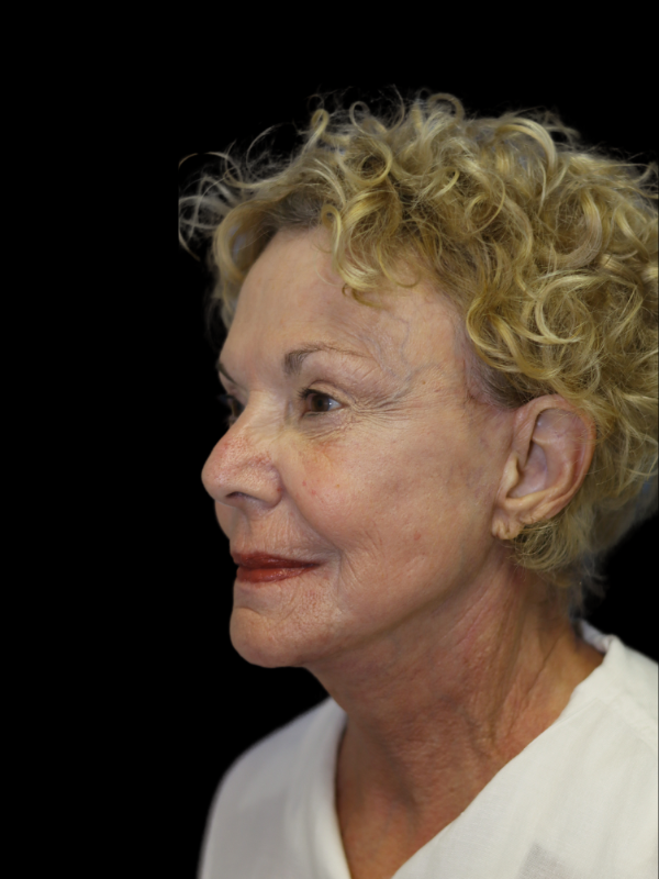 Endoscopic Browlift Gallery Before & After