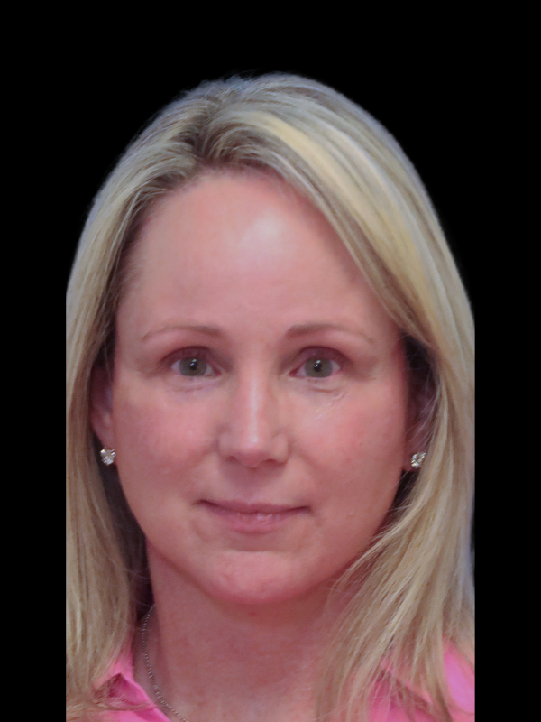 Blepharoplasty Before & After