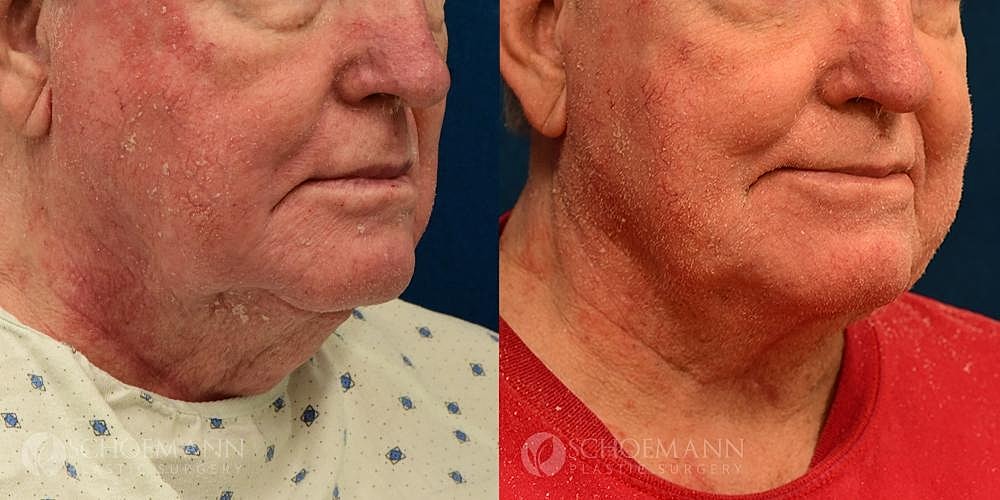 Neck Lift Before & After