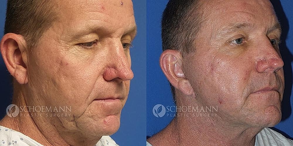 Facelift Before & After