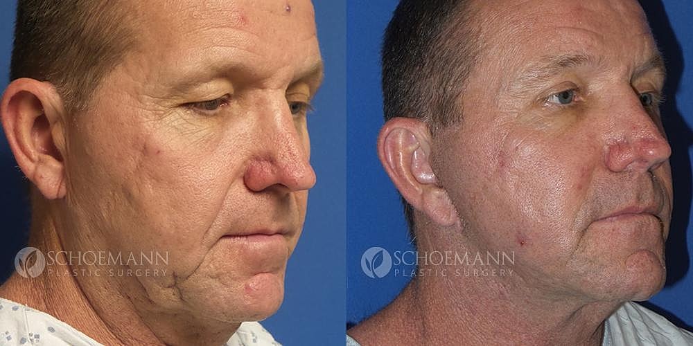 Facelift Before & After
