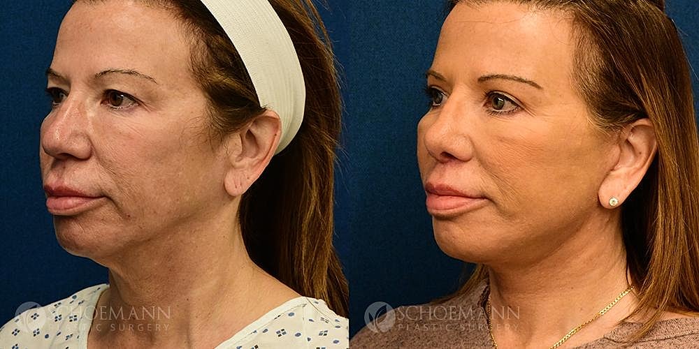 Facelift Before & After