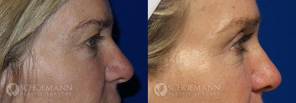 Eyelid Lift Before & After