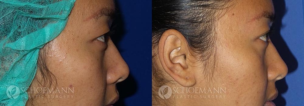 Eyelid Lift Before & After