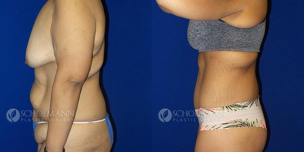 After Weight Loss Surgery Before & After