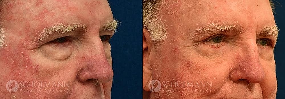 Blepharoplasty Before & After