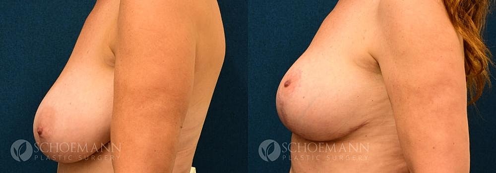Breast Augmentation Before & After