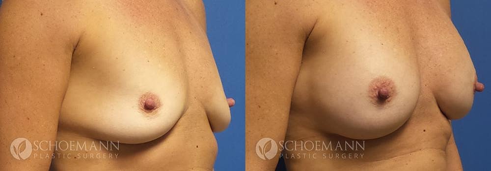 Breast Augmentation Before & After