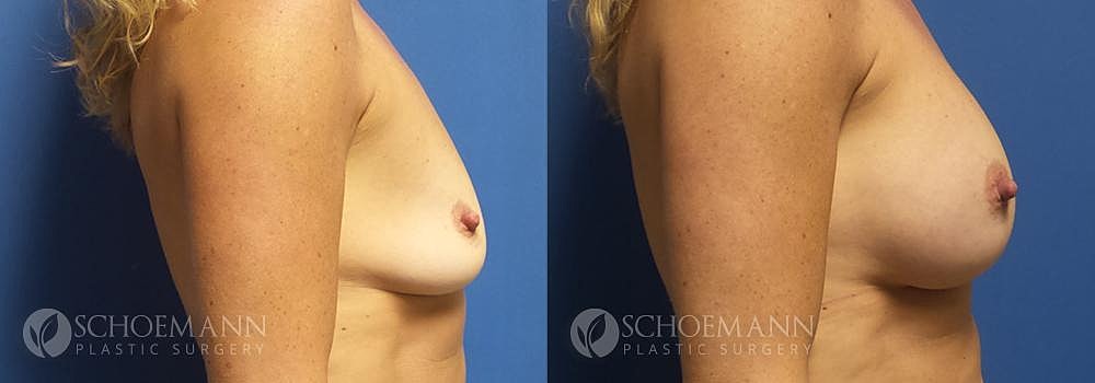 Breast Augmentation Before & After