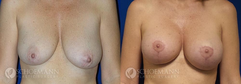 Breast Augmentation Before & After
