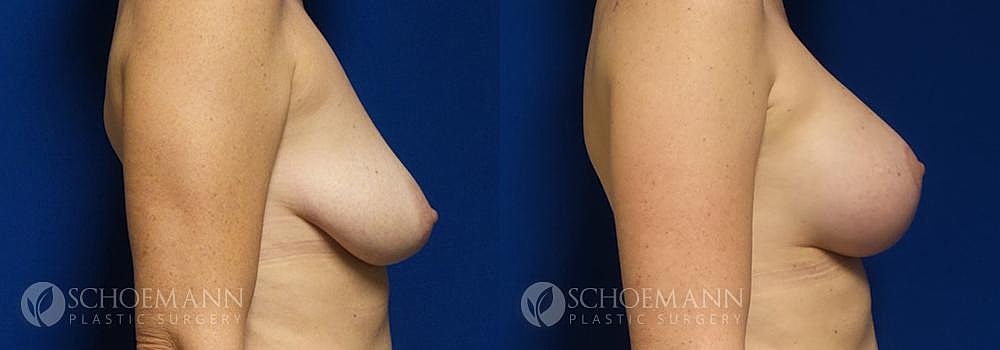 Breast Augmentation Before & After