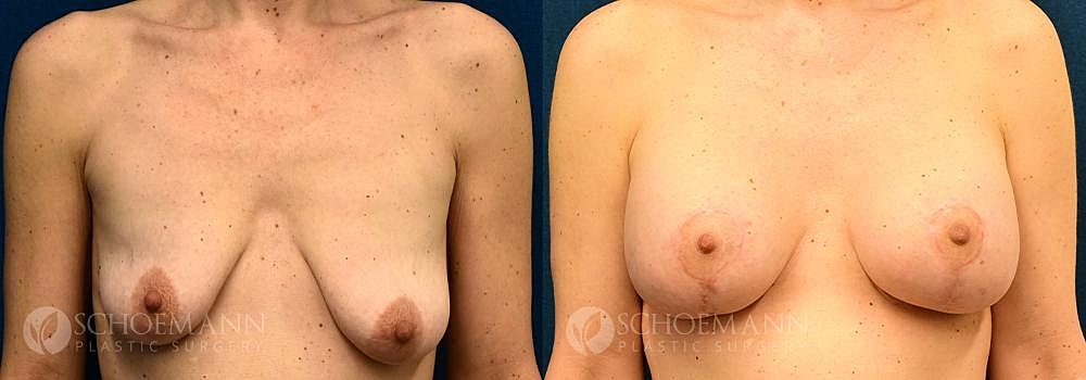 Breast Augmentation Before & After