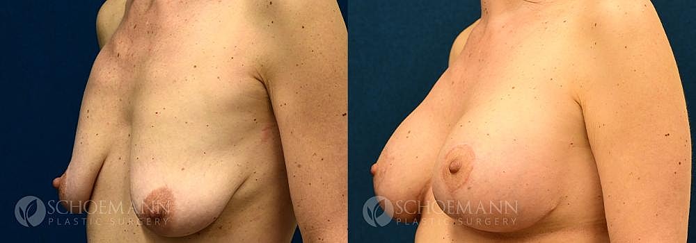 Breast Augmentation Before & After