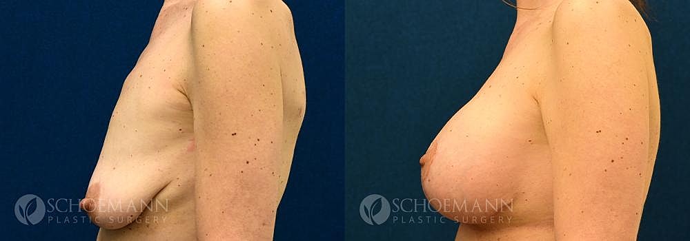 Breast Augmentation Before & After
