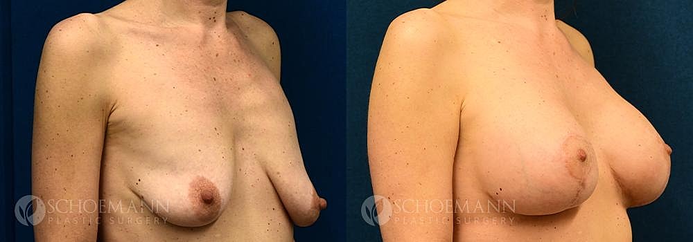Breast Augmentation Before & After