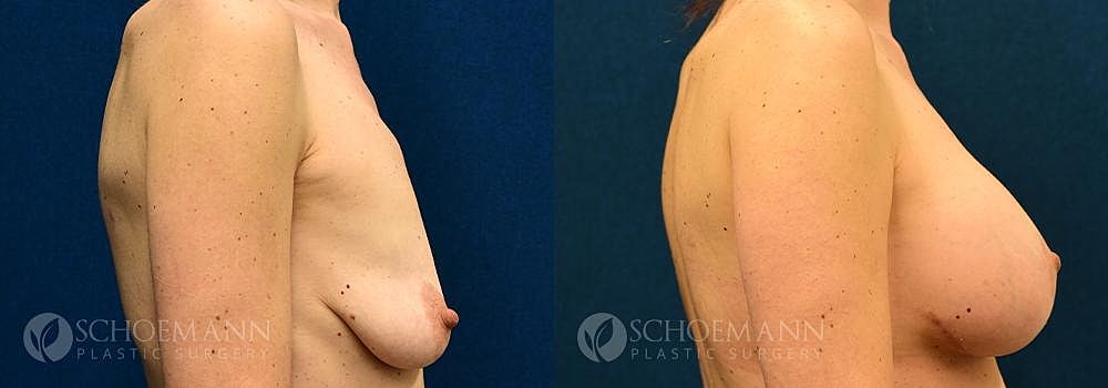 Breast Augmentation Before & After