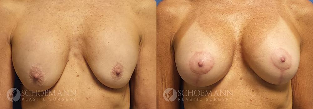 Breast Augmentation Before & After