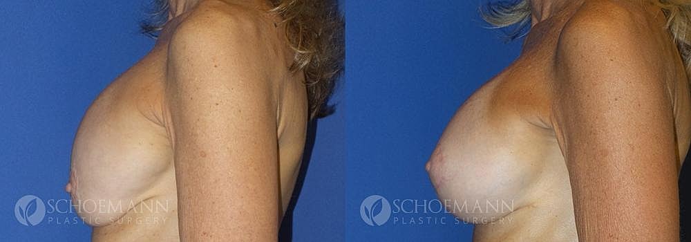 Breast Augmentation Before & After