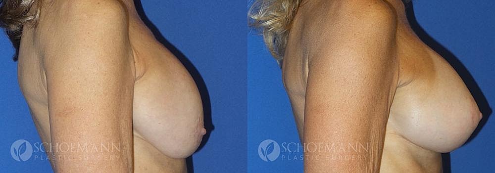 Breast Augmentation Before & After