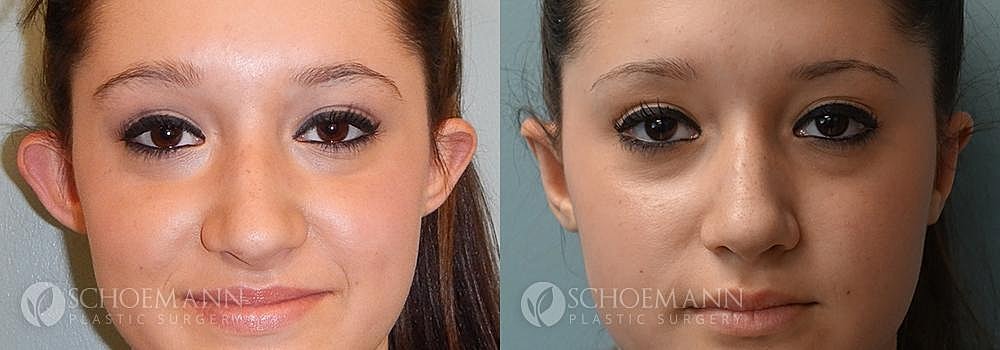Ear Surgery Before & After