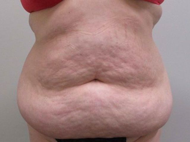 Elite Tummy Tuck Before & After