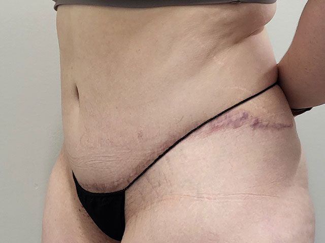 Plus Size Abdominoplasty Before & After