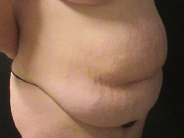 Abdominoplasty Before & After