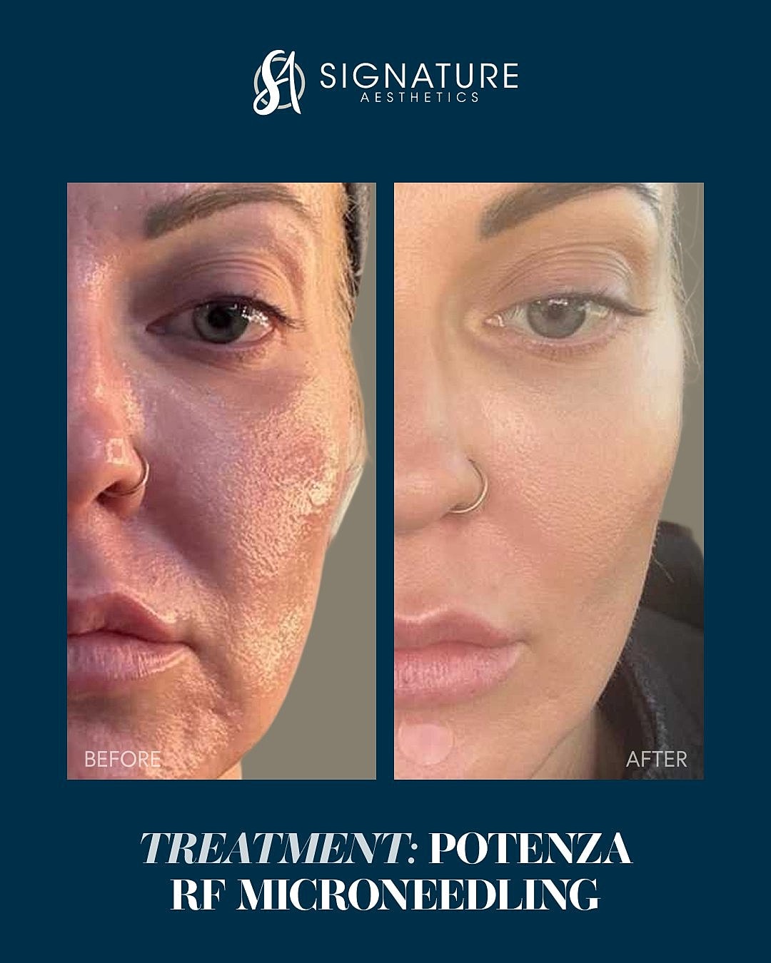 rf microneedling before and after images