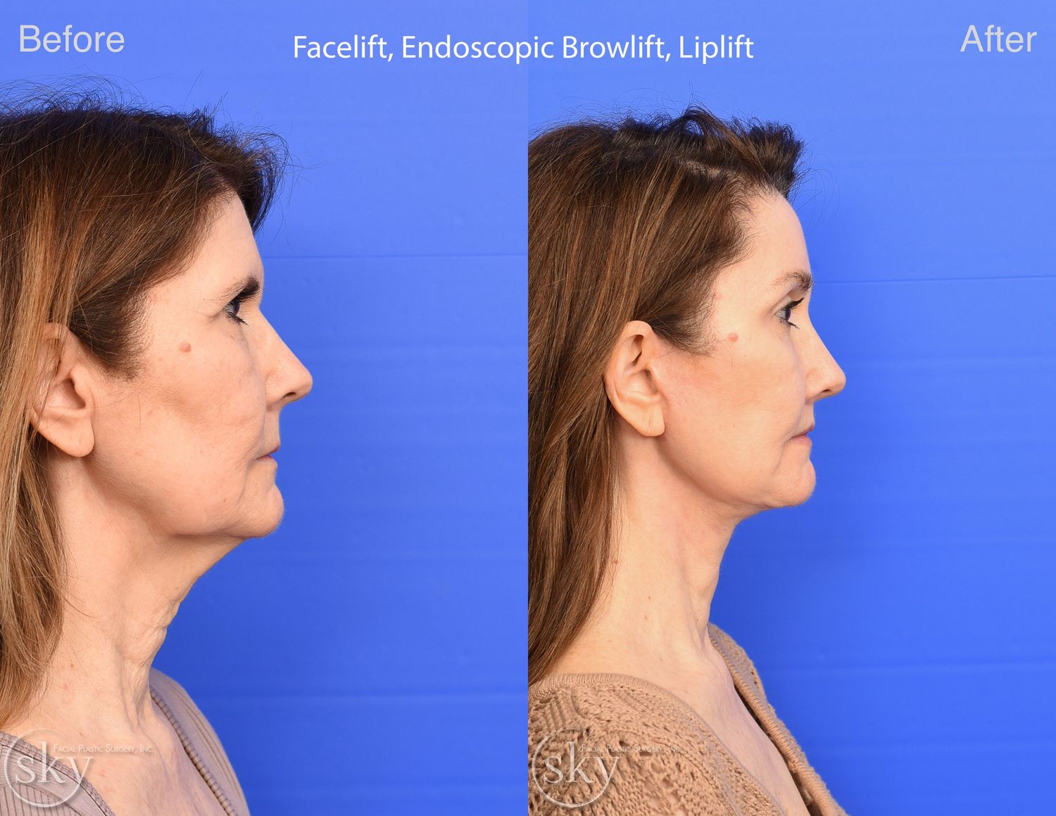 Brow Lift Before & After