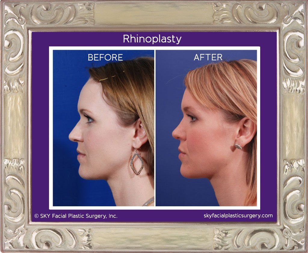 Rhinoplasty Before & After