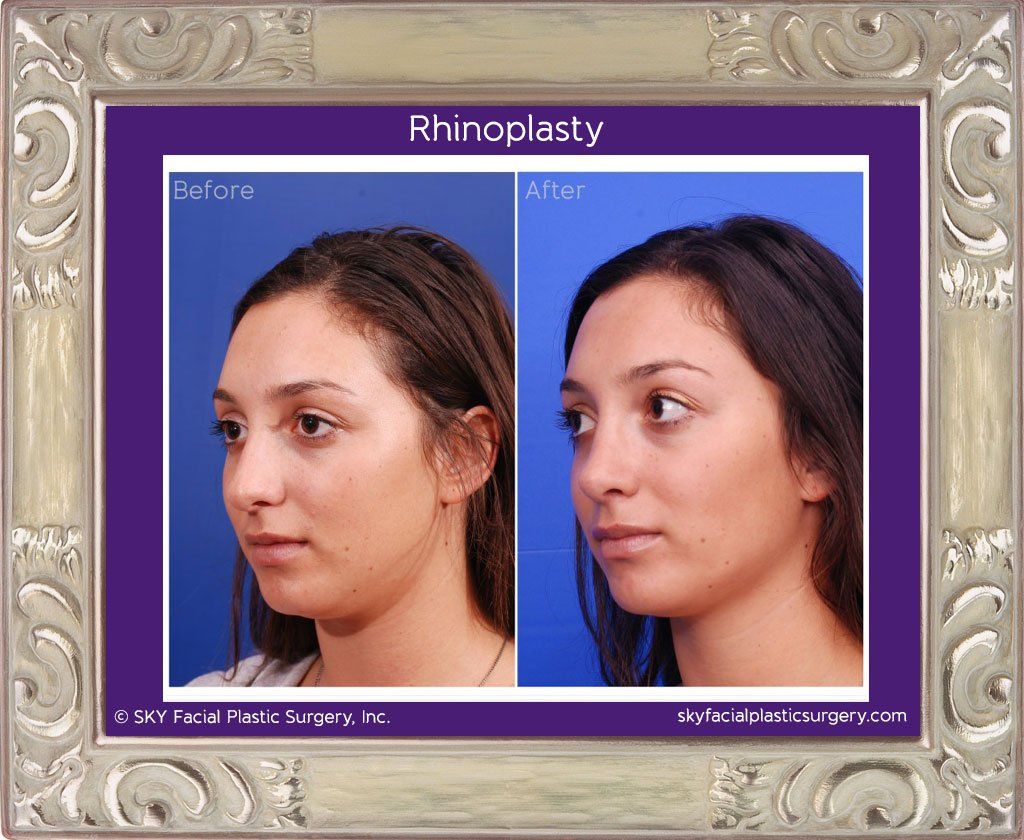 Rhinoplasty Before & After